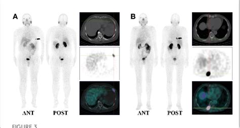 Diagnostic Performance Of 99mTc HYNIC PSMA SPECT CT For Biochemically