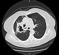 Category:Adenosquamous carcinoma of lung - Wikimedia Commons