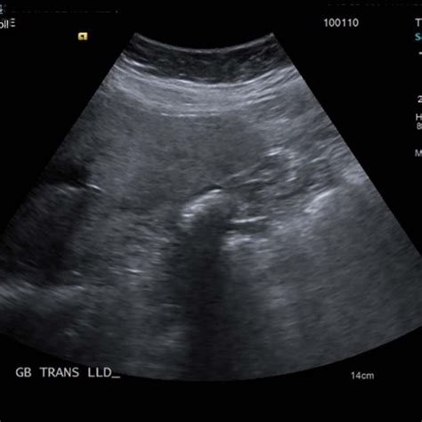 Ultrasound Of The Gallbladder Showing Echogenic Shadow From The
