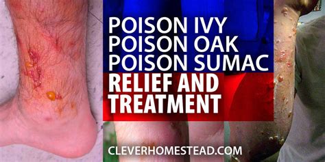 Poison Ivy Poison Oak And Poison Sumac Relief Treatment And Healing