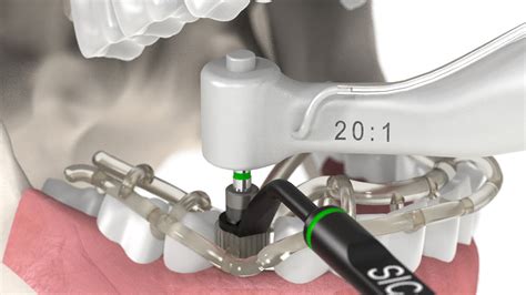 Biohorizons Guided Implant Surgery St Lawrence Dentistry