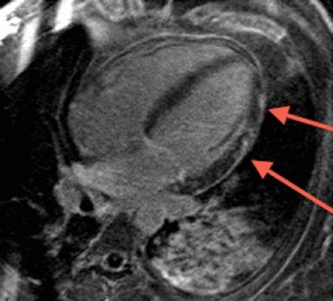 Figure 2 From Imaging Patterns Of Cardiac MRI In The Diagnosis Of