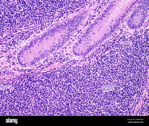 Mantle Cell Lymphoma Light Micrograph Stock Photo Alamy