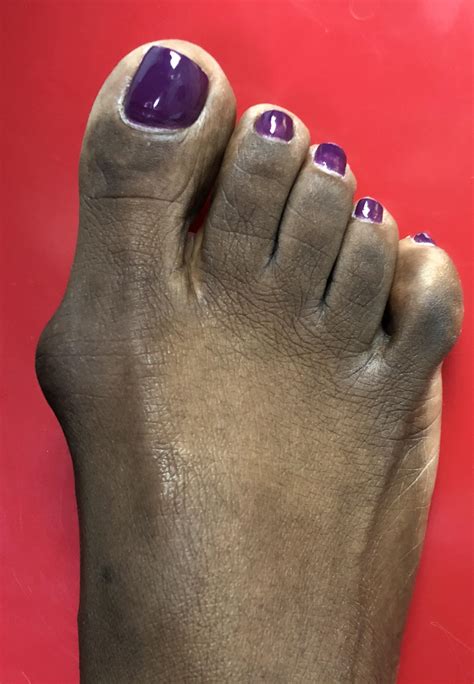 Minimally Invasive Bunion Surgery - https://youtu.be/8LsMM1UqvM0 : r