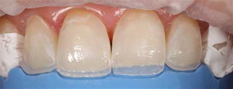 Conservative Esthetic Technique With Direct Composite Bonding ...
