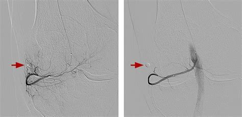 Genicular Artery Embolization (GAE) - Interventional Radiology ...