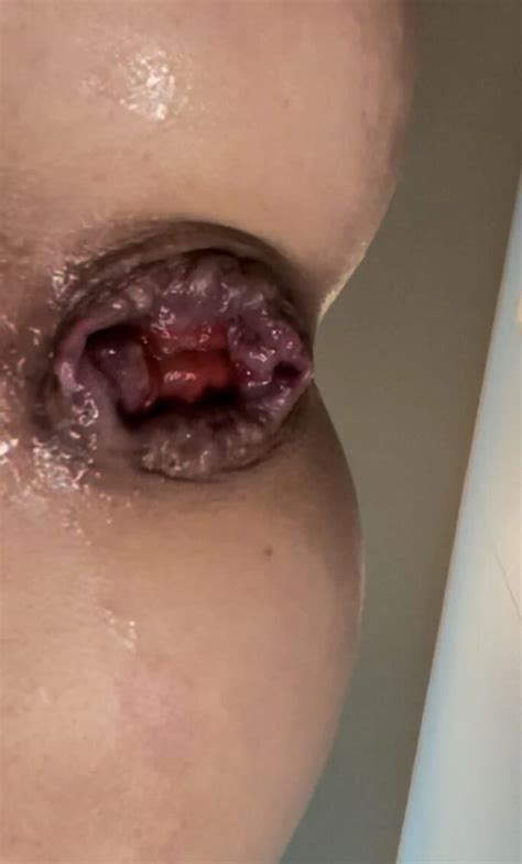 StaceyLovesAnal Stretched Hole 20 Nude Pics XHamster