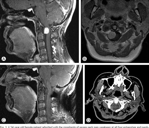 Figure 1 From Surgical Excition Of Spinal Intradural Meningiomas