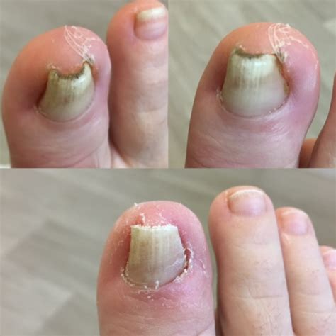 Ingrown Toenails Pulse Podiatry