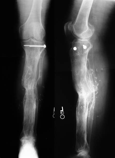 Infected Nonunion: Tibia Case 5 - Dr. Mark Brinker, Houston Orthopedic ...