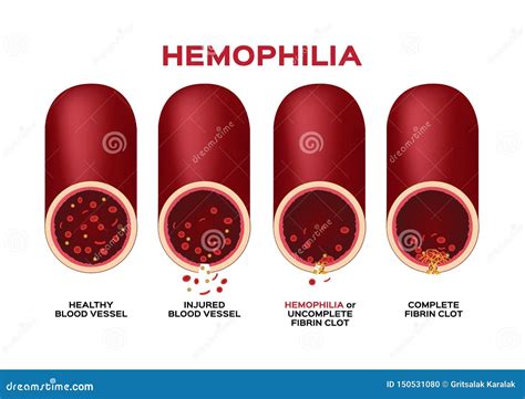 Hemophilia Or Haemophilia And Blood Vessel Vector Bleeding Wound