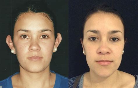 Otoplastia Antes y Después Antes y después