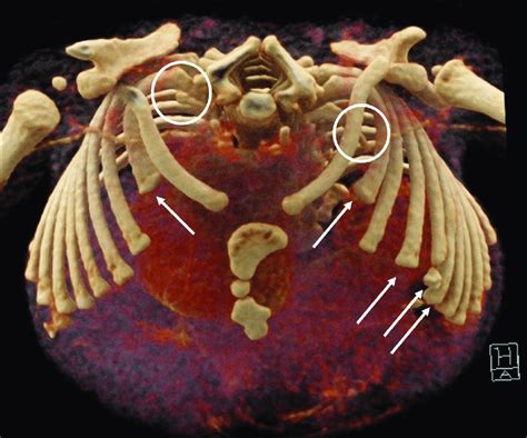 3d Reconstruction Of The Chest Ct Scan Shows Bilateral Hypoplastic