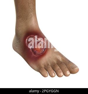 Buruli Ulcer On A Foot Illustration Stock Photo Alamy