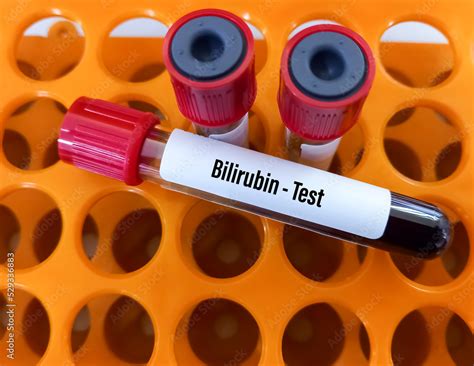 Blood sample for Bilirubin test, Liver function test. Stock Photo ...