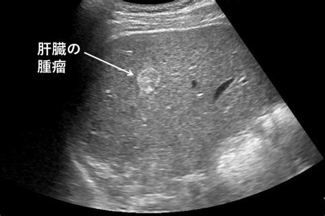 abdominal ultrasound