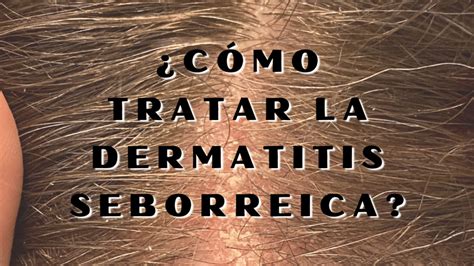 ¿cómo Tratar La Dermatitis Seborreica Los Consejos De Michael