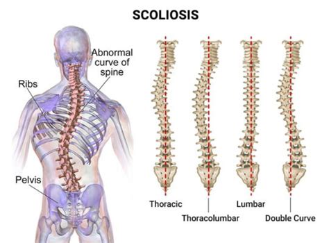 Interpreting Scoliosis Through Radiology Insights Into Spinal Imaging And Diagnosis