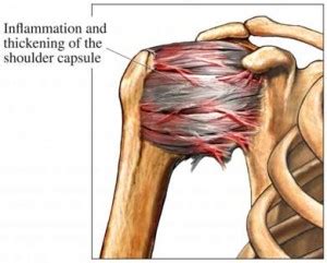 Frozen Shoulder - PT & ME