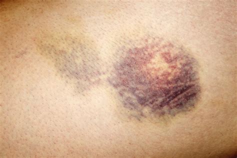 Fases De Um Hematoma