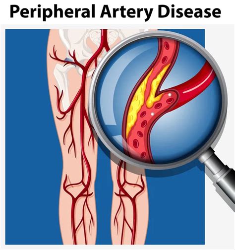 Peripheral Artery Disease Causes And Treatment Options