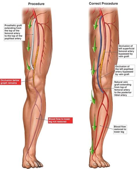 Leg Vein Grafts