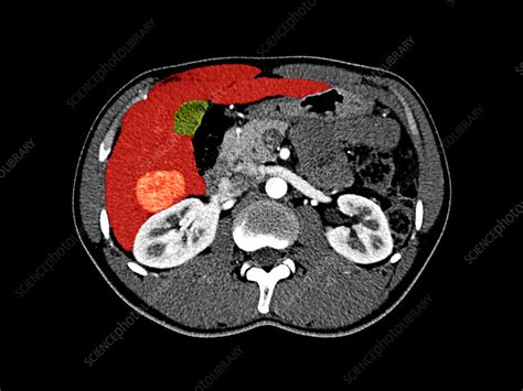 Liver cancer, CT scan - Stock Image - C026/1128 - Science Photo Library