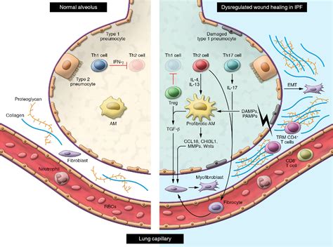 Figure 1 From Immune Dysregulation As A Driver Of Idiopathic Pulmonary