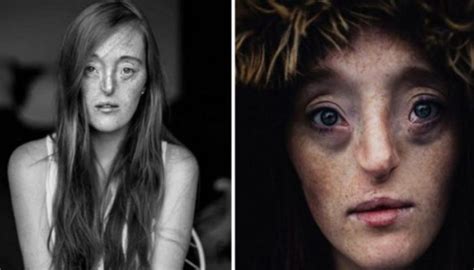 Despite Her Unusual Facial Deformity The Model Proves That True Beauty