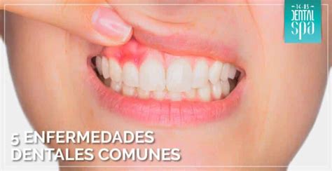 Problemas Dentales En Dentici N Mixta Prevenci N Y Soluciones