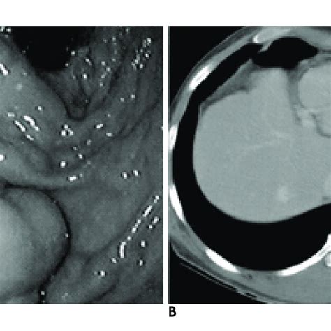 A Year Old Man With Gastric Variceal Bleeding A Endoscopy On