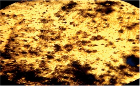 Лазерофорез, магнитофотофорез, Оценка эффективности реминерализации ...