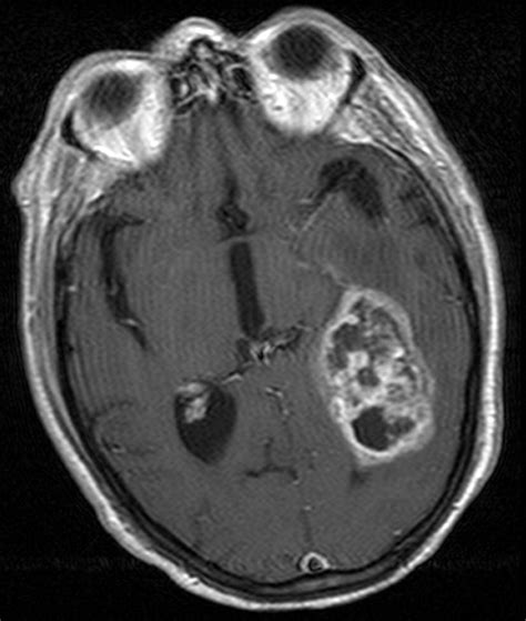 Glioblastoma Multiforme Radiographics