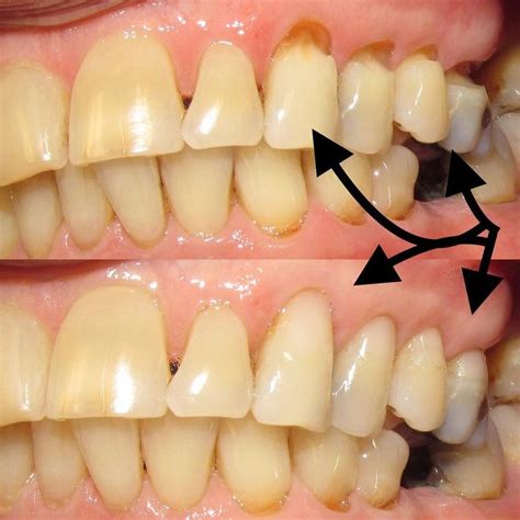 Fixing Abfraction Lesions Dental Problems Dental Dentistry