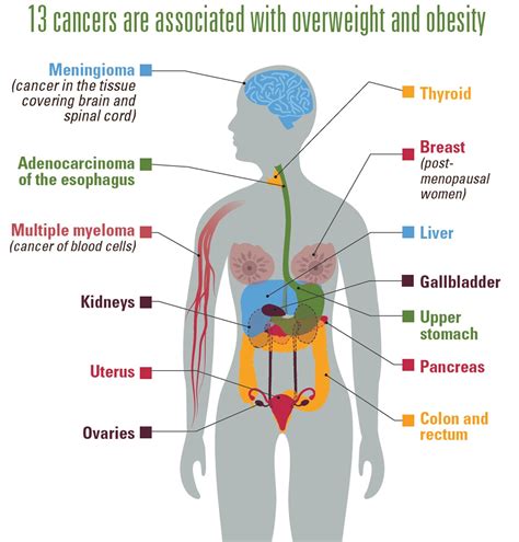 Cancer and obesity | VitalSigns | CDC