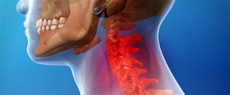 how to know if you have whiplash