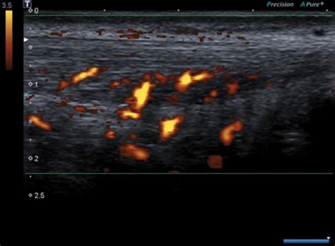 Edema And Hypervascularization Of Kagers Fat Pad Tendon Infiltrated