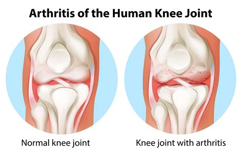 Knee Arthritis: Symptoms, Diagnosis, Treatment | MIMIT Health