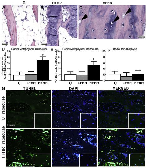 Increased Empty Lacunae And Tunel Stained Cells In Distal Radial