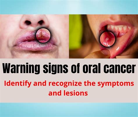 oral cancer