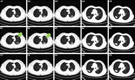 A General Approach For Automatic Segmentation Of Pneumonia Pulmonary