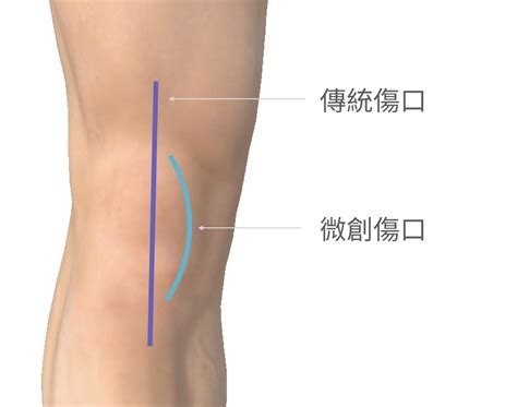 微創膝關節手術不迷思：談談常見的微創手術說法有哪三大類｜蔡尚聞醫師 病症說明｜臺北榮總關節重建科
