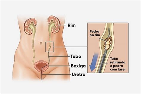 Como É A Cirurgia De Pedra Nos Rins - Cirurgia para pedra nos rins: quando fazer, tipos e recuperação - Tua Saúde