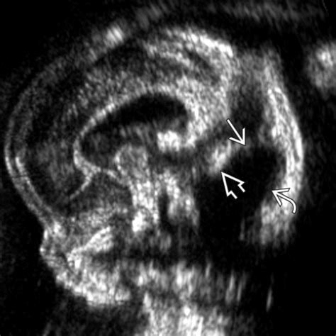 ecografia malformazione dandy walker dandy walker malformation