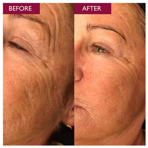 Glycolic Acid For Skin Skinician