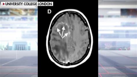 New Covid Complication Study Shows Virus Could Cause Neurological