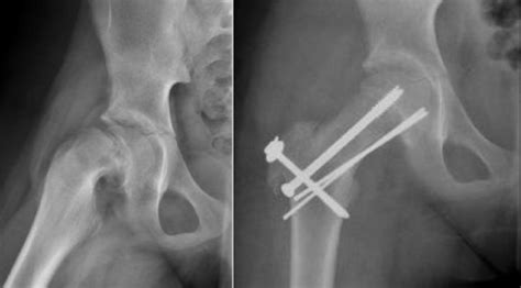 hip replacement St. Louis, MO | Hip Revision Surgery, Missouri | Periacetabular Osteotomy (PAO ...