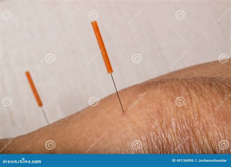 Acupuncture Treatment on Leg Stock Photo - Image of healer, china: 49136896