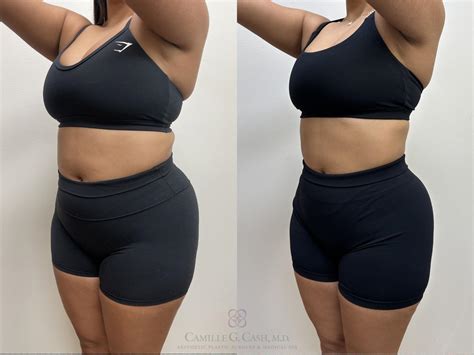 Semaglutide Weight Loss Before And After Pictures Case 690 Houston Tx Camille Cash Md