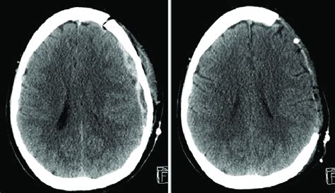 Left Repeat Head Ct Scan Obtained With Recurrent Epidural Hematoma